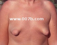tubular hypoplastic small breasts