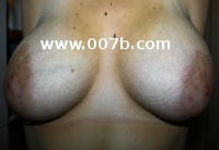 breasts