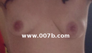 breasts with insufficient glandular tissue