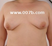 40B breasts