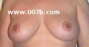breasts of a woman pregnant at 13 weeks