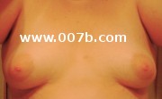 breasts