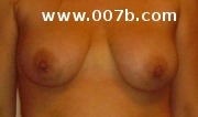 20 year old's breasts