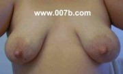 lactating breasts