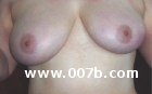 lopsided breasts