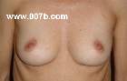 breasts with small areola