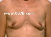 small breast