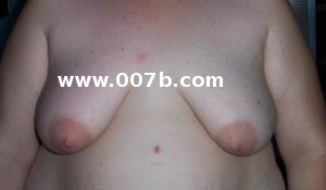 tubular breasts