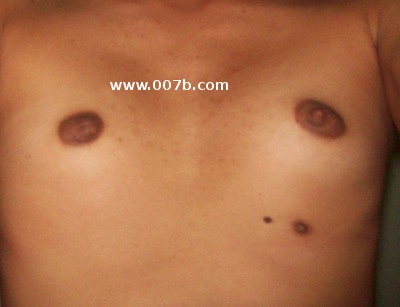 Misshapen Breasts - Breast Gallery - not normal breasts: surgically altered ...