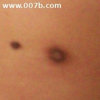 supernumerary breast closeup