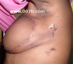 left breast after breast reconstruction due to cancer