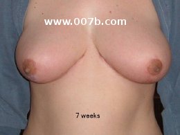 breasts after breast reduction