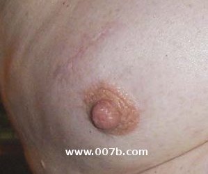 lumpectomy scar on a male breast