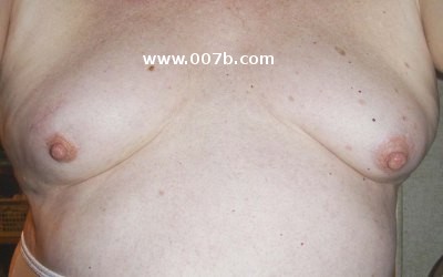 breasts of a male breast cancer survivor