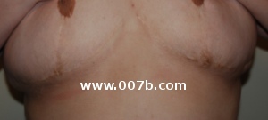 breast reduction scars under breasts