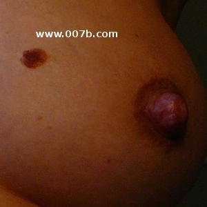 polythelia - additional nipple