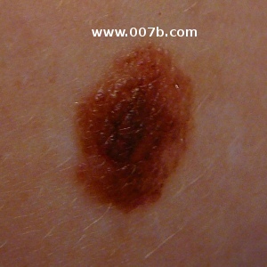 polythelia - additional nipple