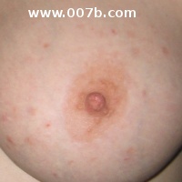acne on breast