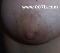 hair around the areola