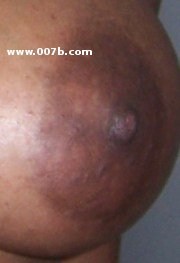 nipple and areola of a 20-year old