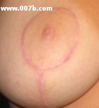 a 21-year old woman's nipple with scar around the areola after breast reduction