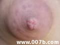montgomery glands showing on an areola of a pregnant woman