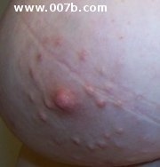 prominent montgomery glands