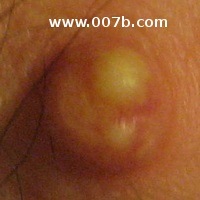 cyst on nipple