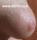 nipple on tubular breast