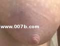 visible vein in areola